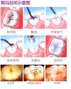 怎样预防蛀牙?