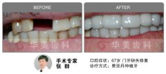 缺牙后应及时镶牙