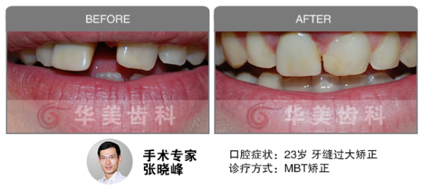 告别牙齿稀疏,重获美味人生